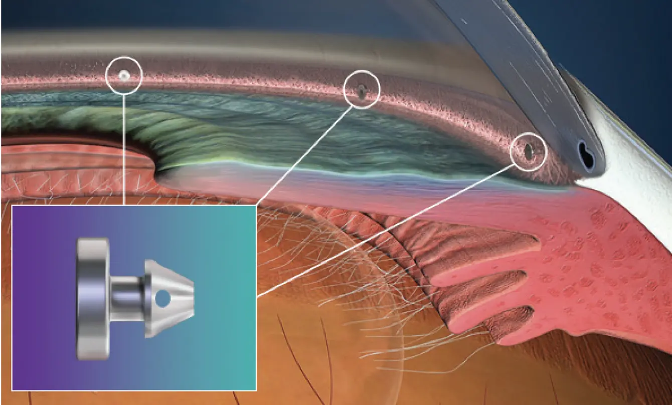 Illustration that diagrams how iStent Infinite works. Zoomed in to the cellular level.