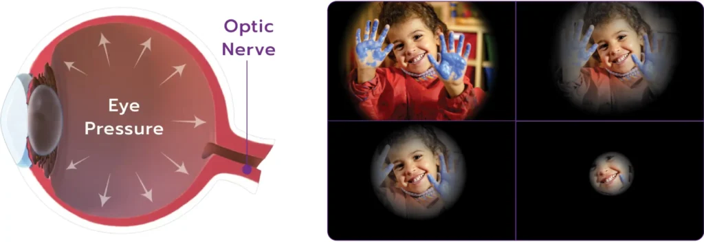 Illustration of the inside of an eye demonstrating pressure pressing outward against the lining of the eye. It also highlights the Optic Nerve at the base of the eye. Next to it is a 4-panel view of a small child, where each section shows an increasingly narrow field of view to simulate the changes your sight can go through.